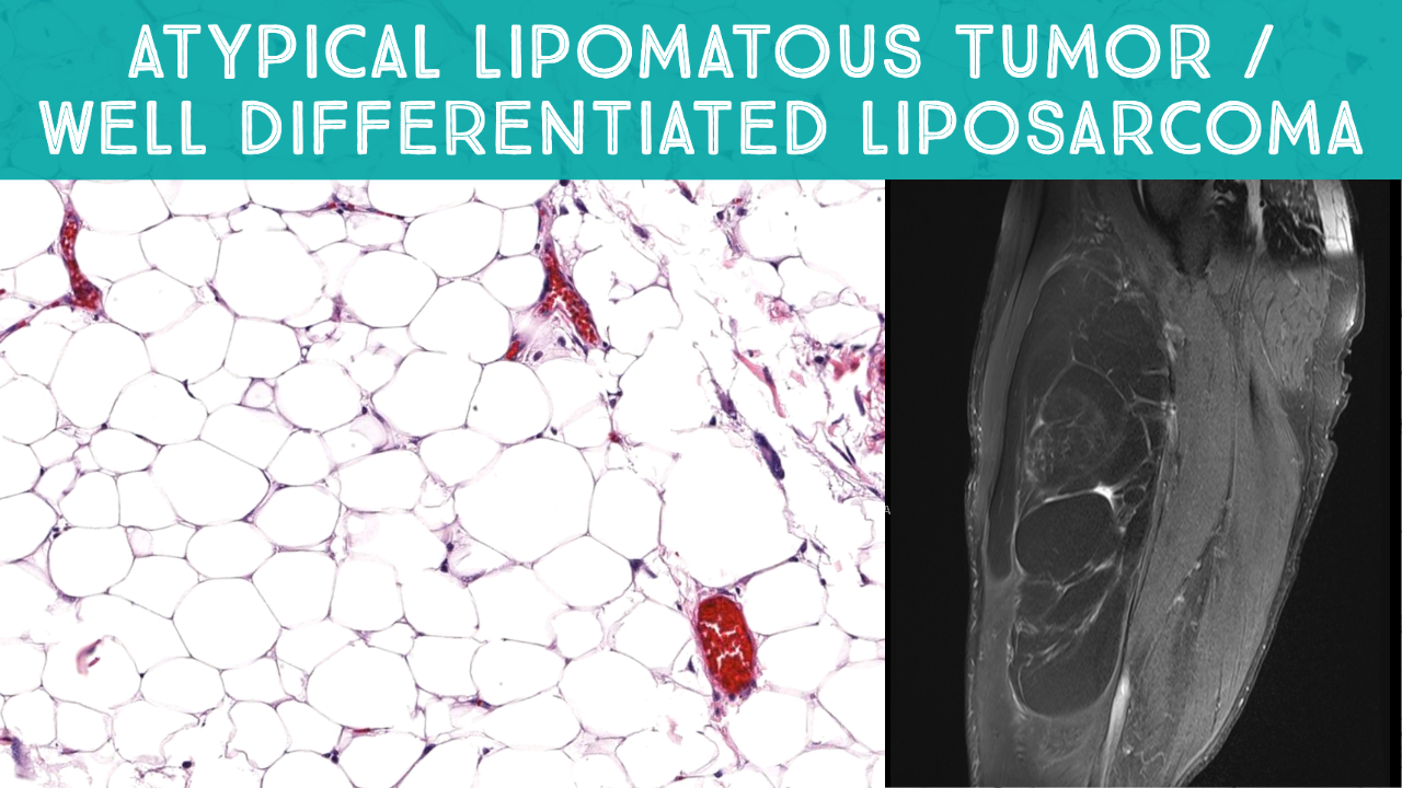 Well differentiated / "Atypical lipomatous tumor" mimicking